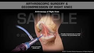 Arthroscopic Surgery amp Decompression of Right Knee [upl. by Annayram16]