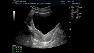 ECOGRAFÍA ABDOMINO PÉLVICA  ECOGRAFÍA DE ÚTERO Y ANEXOS  ULTRASONIDO ABDOMINAL ECOGRAFÍA OVARIOS [upl. by Akital]