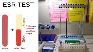 Esr Test ProcedureEsr Test by Westergren MethodEsr TestAdnanMLT [upl. by Romeyn496]