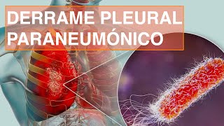 Derrame Pleural Paraneumónico [upl. by Bacon]