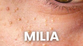 3 Proven Strategies to Remove Milia that WORK [upl. by Clardy]