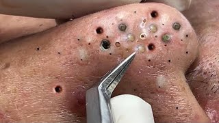 Big Cystic Acne Blackheads Extraction Blackheads amp Milia Whiteheads Removal Pimple Popping  2244 [upl. by Aneeres261]