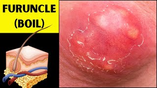 Boils Furuncles Unmasked  What You Need to Know Causes Signs amp Symptoms Treatment Prevention [upl. by Aihsek451]