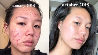 Acne Skincare Routine FINALLY [upl. by Eglantine]