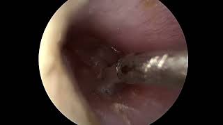 Ear tube placement myringotomy [upl. by Ivers567]