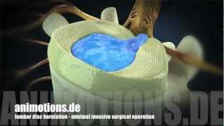 Herniation quotlumbarquot Treatment Surgery 3D Animation [upl. by Elleron]