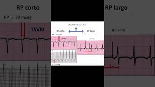 Cómo Identificar Tipos de Taquicardia en el Electrocardiograma  Dr Jose Porto [upl. by Ellita273]