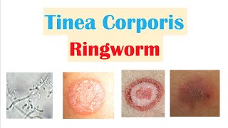 Ringworm Tinea Corporis  Causes Risk Factors Signs amp Symptoms Diagnosis and Treatment [upl. by Renner447]