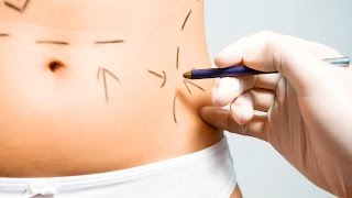 2 Main Types of Tummy Tuck  Plastic Surgery [upl. by Heurlin292]