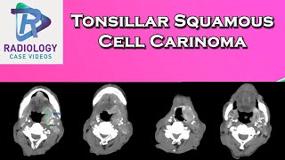 Tonsillar Squamous Cell Carinoma [upl. by Pancho]