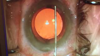 Dropless Cataract Surgery [upl. by Mattie868]