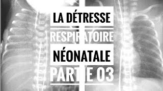 La détresse respiratoire néonatale partie 03 [upl. by Ttessil]