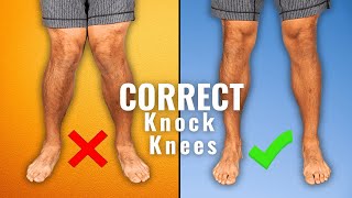 Top 5 Effective Exercises to CORRECT Knock Knees [upl. by Cyma]