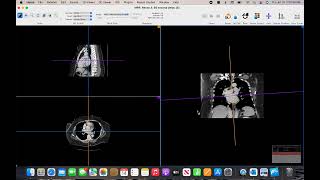 DICOM viewer for Apple  Using Horos [upl. by Tamara]