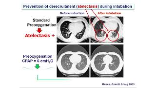 WCA 2024 Symposium：Enhancing Intubation Safety with Two Preoxygenation Techniques in OR [upl. by Ioj]