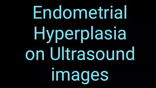 Endometrial Hyperplasia on Ultrasound Imaging [upl. by Adranoel385]