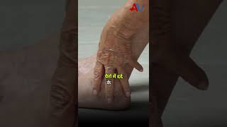 VARICOSE VEINS  Symptoms  Swollen Legs Pain in legs varicoseveins varicoseveinstreatment [upl. by Karin]