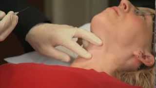 Laryngeal Botox Injection  Dr Ekbom at Mayo Clinic [upl. by Tneicniv21]