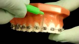 Bracesquestionscom  Brushing With Braces How to Brush Teeth [upl. by Brieta]