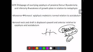 SCFE SLIPPED CAPITO FEMORAL EPIPHYSIS [upl. by Eilegna105]