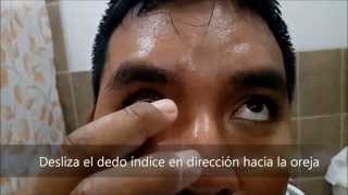 INSERCION Y EXTRACCION DE UNA PROTESIS OCULAR [upl. by Landre757]