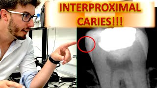 ALL ABOUT Interproximal Caries Radiology Tutorial How to read bitewings and periapical radiograph [upl. by Elleron]