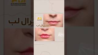 Central Lip Lift by Dr Alireza Mohebbi [upl. by Vharat176]