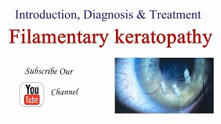 Filamentary Keratopathy  Keratitis Introduction Causes Diagnosis and Treatment  Optometry Club [upl. by Teddi933]