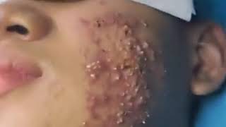 His Face Acne  Blackhead  Blackhead Removal on forehead  Remove Blackhead [upl. by Klapp]