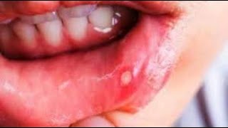 How To Get Rid Of Canker Sores Fast जीभ पर छाले होने का कारण और घरेलू उपचार  Tongue Blisters [upl. by Eyahsal]