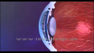 S 040 Augeninnendruck  PAL 169 S 040 Intraocular pressure  PAL 169 [upl. by Azila]