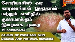 சோரியாசிஸ் பிரச்சனைக்கு நிரந்தர தீர்வு  Psoriasis Natural Treatment Tamil  Skin Disease Treatment [upl. by Hudgens]