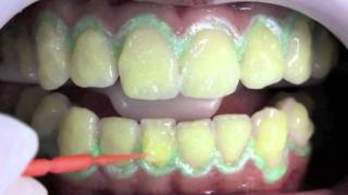 In  Office Dental Whitening Total Blanc H35 [upl. by Marjory]