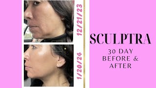 Sculptra 30 Day Before amp After 2 Vials collagen sculptra [upl. by Ashleigh648]