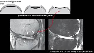 Анатомия и повреждение хряща коленного сустава и остеохондральные повреждения Учеваткин АА Часть 3 [upl. by Dareen625]
