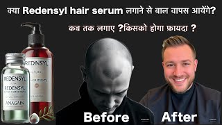 क्या Redensyl hair serum लगाने से बाल वापस आते है  Redensyl बंद करने पर क्या बाल चले जाएँगे [upl. by Aloisia]