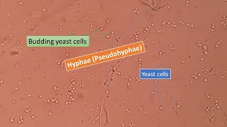 KOH mount of sputum under the Microscope showing fungal elements yeast cells and fungal hyphae [upl. by Warton]