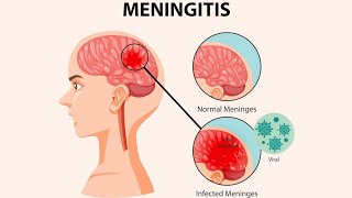 Meninges  Meningitis symptoms Diagnosis And Treatments [upl. by Celeste]