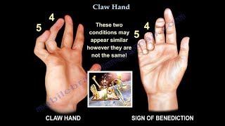 Claw Hand Ulnar Claw Hand  Everything You Need To Know  Dr Nabil Ebraheim [upl. by Ellenahc57]