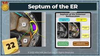 KOR Anatomy22 Septum of the Extensor Retinaculum wrist MRI [upl. by Yramliw]