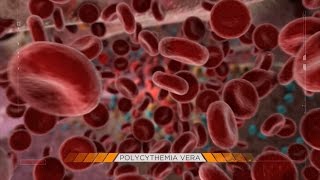 Behind the Mystery Polycythemia Vera [upl. by Air]