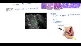 Endometrial Cancer and Hyperplasia for USMLE [upl. by Mackenie]