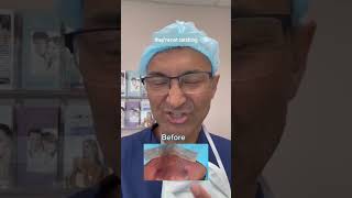 RHINOPLASTY ON BIG NOSE DR TANVEER JANJUA NEW JERSEY [upl. by Ahsinak189]