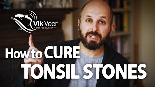 How to Cure Tonsil Stones [upl. by Howell]