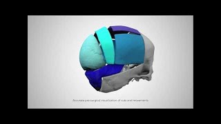 3D Systems VSP Cranial Service [upl. by Acim]