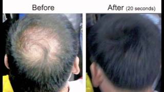 Hair Loss Treatment Balding Crown  Caboki video clip [upl. by Genisia297]