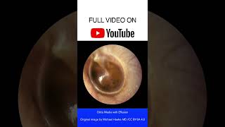 Otitis Media with Effusion Otoscopy [upl. by Subocaj6]