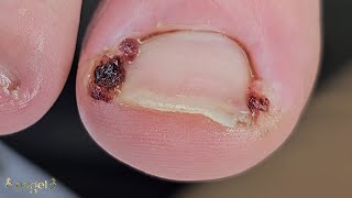 😱GRANULOMAS BILATERAIS INTENSOS E CRÔNICOS satisfying ingrowntoenail [upl. by Wina686]