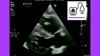 Echocardiography [upl. by Labinnah7]