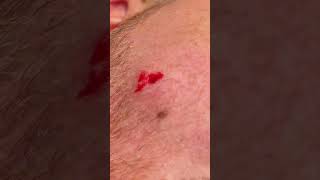 CHEEK CYST [upl. by Graeme147]